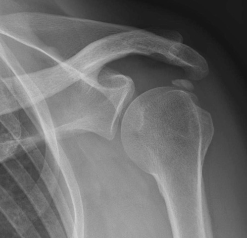 Radiografia di spalla con presenza di calcificazione